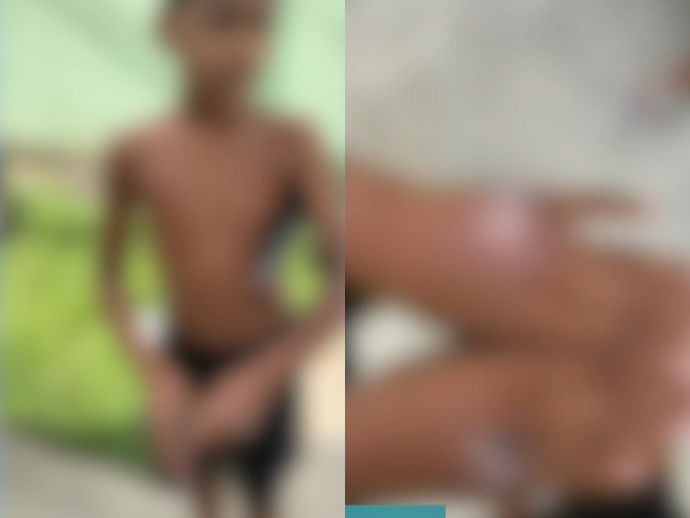 Criança de 11 anos tem mãos queimadas com chapinha por beber iogurte sem permissão